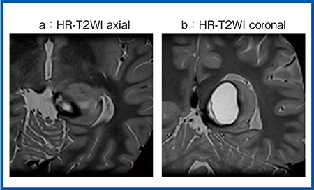 図2　症例2：HR-T2WIによる腫瘤性病変の描出