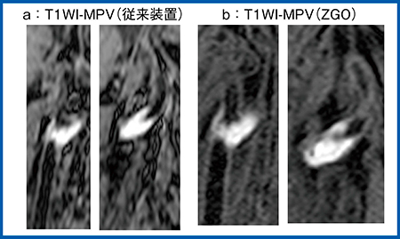 図3　症例3：頸動脈狭窄におけるVWIでのプラーク描出能の比較