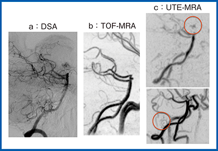 図4　症例4：UTE-MRAによる脳動静脈奇形コイル塞栓術後のフォローアップ