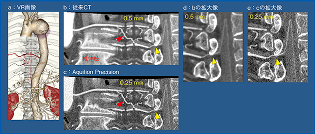 図2　Aquilion Precisionによる骨と血管の鑑別