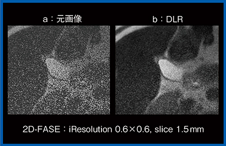 図6　DLRを用いた胆嚢のhigh resolution imaging