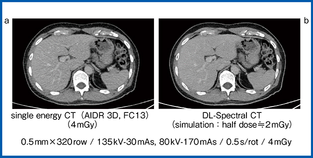 図2　Single energy CTとDL-Spectral CTによるDECT画像の比較