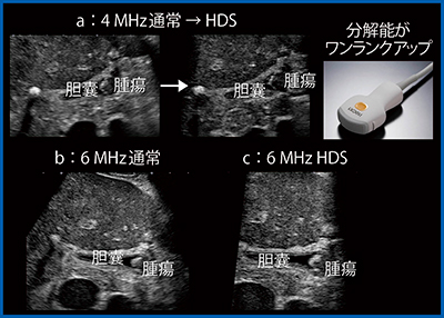 図4　転移性胆囊腫瘍のHigh-density Scan（W.I.P.） a：4MHz通常→HDS　b：6MHz 通常 c：6MHz HDS