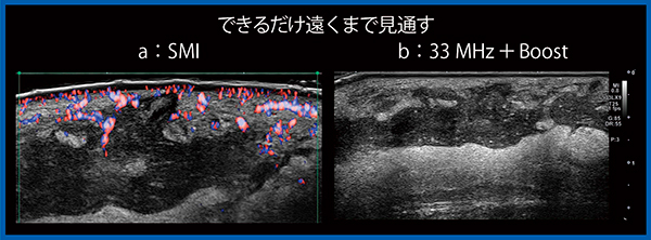 図6　毛嚢炎・皮下膿瘍における33MHz＋Boost（W.I.P.）（b）による深部の描出