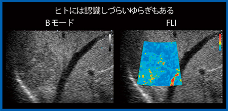 図9　肝血管腫のFluctuational Imaging（W.I.P.）