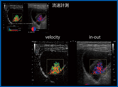 図11　超高速CVI（W.I.P.）による悪性黒色腫の胆嚢転移の描出