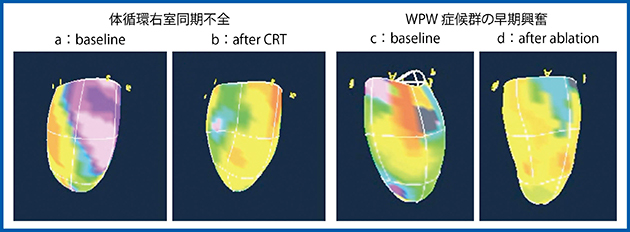 図4　Activation Imagingの臨床応用：体循環右室同期不全5），6）とWPW症候群7）