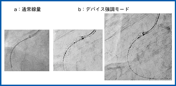 図1　デバイス強調モード：経皮的冠動脈形成術