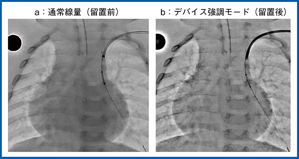 図4　デバイス強調モード：肺動脈への冠動脈ステント留置