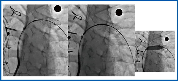 図7　心房・大血管スイッチ手術後の左肺動脈へのセルフエクスパンダブルステント留置