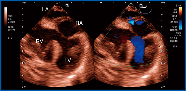 図3　症例2：l-DORV，PA症例の卵円孔開存に伴うシャント血流の評価（5か月，5.7kg，男児）