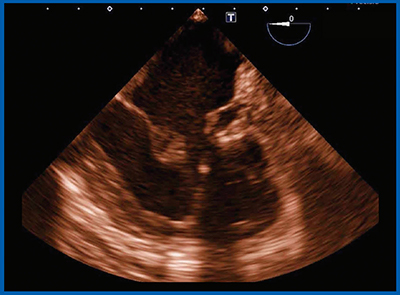 図5　症例3：SRV，DORV症例の僧帽弁の腱索や付着の観察（13歳，33kg，男児）