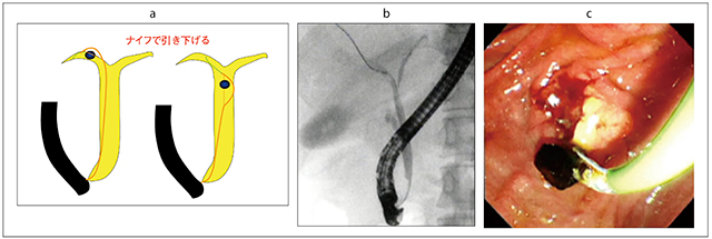 図19　パピロトームによる肝内胆管嵌頓気味結石の除去 a：肝内胆管へ迷入した嵌頓結石への対応　b：パピロトームで結石を移動させる　c：乳頭から結石が排出された