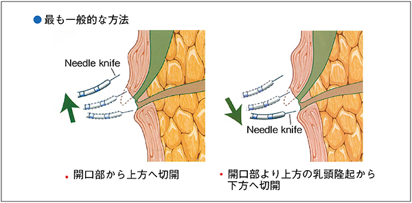 図11　Needle knife（freehand） precut papillotomy