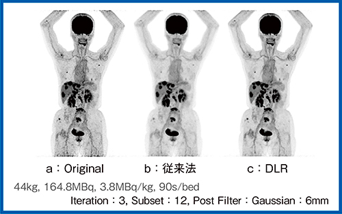 図8　DLR画像再構成の効果（W.I.P.） （症例7：右副乳がん多発転移）