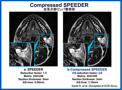 図1　左耳介部リンパ管奇形 SPEEDER（a）とCompressed SPEEDER（b）の画像比較