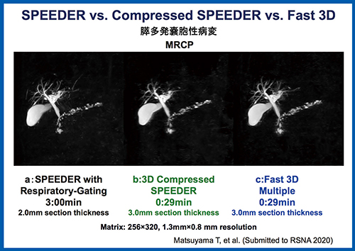 図3　膵多発囊胞性病変 SPEEDER（a）とCompressed SPEEDER（b），Fast 3D Multiple（c）の画像比較