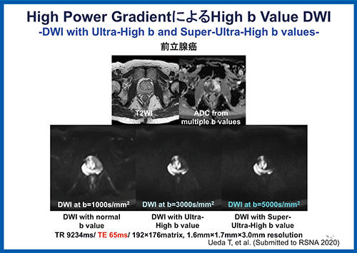 図5　前立腺がんにおけるHigh Power Gradientによる高b値DWI