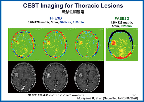 図6　転移性脳腫瘍 CEST imagingにおける3Dおよび2D撮像法の画像比較
