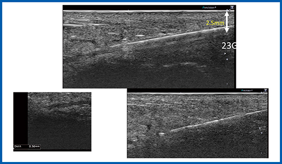 図7　Yubi Punにおける超音波ガイド下穿刺 33MHzの超・超高周波リニアプローブを用いることで，わずか0.5mmの血管でも確実な穿刺が可能である。