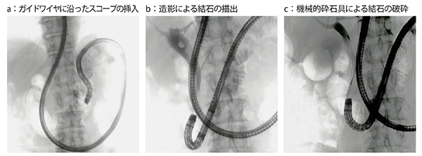 図2　症例2：胃全摘術後（R-Y再建）に対するBE-ERCP