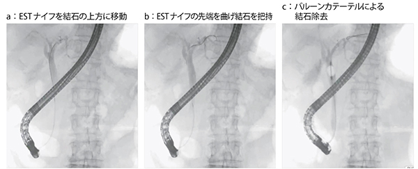 図5　症例4：左肝内胆管内の微小結石への対応