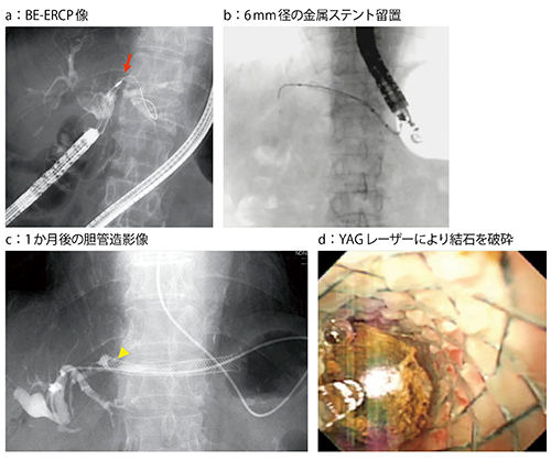 図7　症例5：胆管空腸吻合術＋R-Y再建後の肝内胆管結石