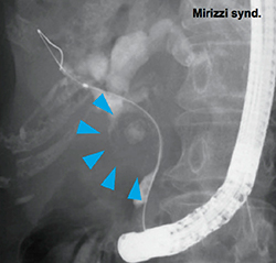 図8　Mirizzi syndromeにおける嵌頓結石
