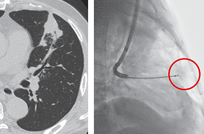 図3　Ultimax-iを用いて行う気管支鏡検査の症例画像 腹側の病変を白とびさせることなく描出。低被ばくで高画質な画像が得られる。