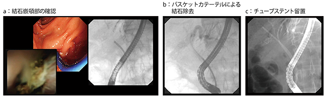 図3　症例3：肝門部狭窄・左肝内胆管拡張症例へのEHL
