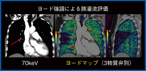 図3　肺血栓塞栓症