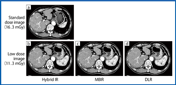 図4　DLRによる高精細腹部CTの低線量化