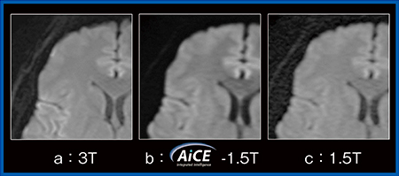 図1　頭部の拡散強調画像における3T画像とAiCEを適用した1.5T画像の比較 （画像ご提供：国際医療福祉大学・田島　拓先生）