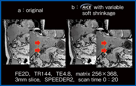 図4　Variable soft shrinkage によるSPEEDER由来ノイズの低減：腹部MRI