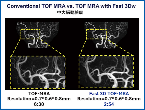 図3　右中大脳動脈瘤 time of flight法にて撮像したMR angiographyのSPEEDERとFast 3D wheelの比較