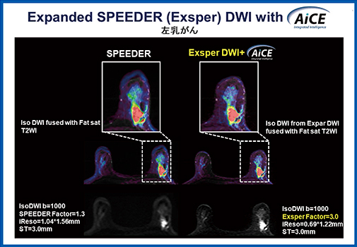 図4　左乳がん SPEEDERによる左乳がんのDWIとExsperを用いて高空間分解能化したDWIの画像比較