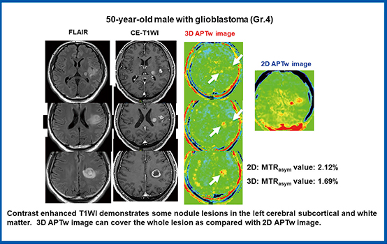 図5　多発転移性脳腫瘍 CEST imagingによる3Dおよび2D撮像法で得たAPT Imagingの比較