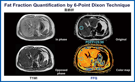 図6　脂肪肝 6-point DIXON法によるchemical shift-encoded proton density fat fraction quantification（FFQ）