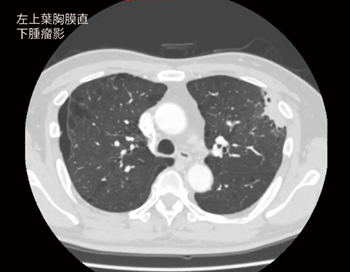 図13　症例2：左上葉胸膜直下腫瘤影
