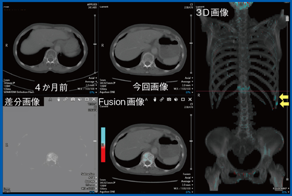 図2　症例2：80歳代，女性，食道がんおよび早期胃がん術後，骨折疑い