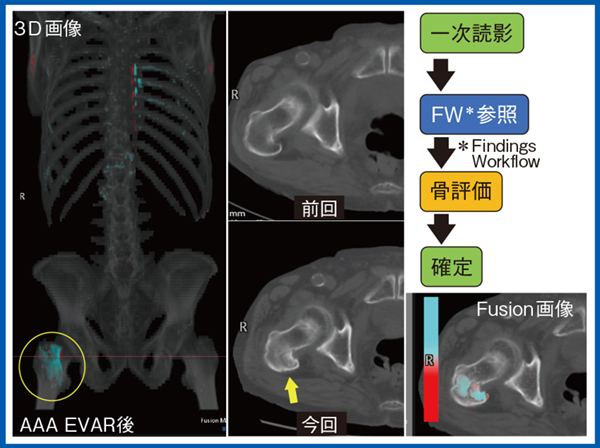 図5　症例5：80歳代，男性，AAAのEVAR後，大腿骨骨折