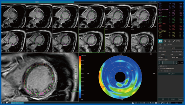 図2　LGE定量解析：拡張型心筋症