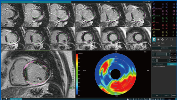図3　LGE定量解析：心サルコイドーシス