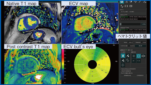 図4　MRI T1マッピングによる心筋組織性状の評価