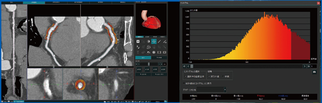 図5　心臓CT解析におけるFAIの画像（左）とヒストグラム解析（右）