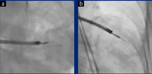 症例3 a：通常の透視像， b：新画像処理条件の透視像 bでは，経気管支針生検（PeriViewFLEX，オリンパス製）の針先もより明瞭に見える。