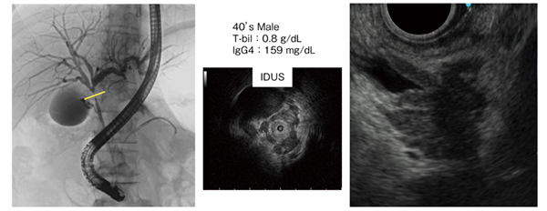 図3　症例2：肝門部領域胆道がん（40歳代、男性）