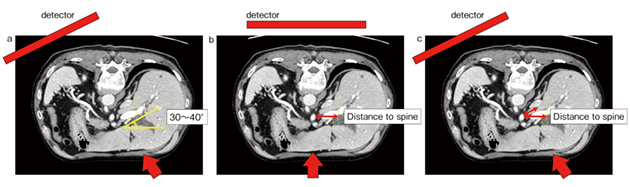 図6　症例3：左右胆管の位置とCアームの角度