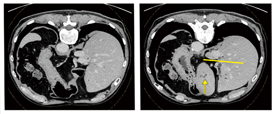 図11　症例5：CT画像を用いた胆管枝角度の推定