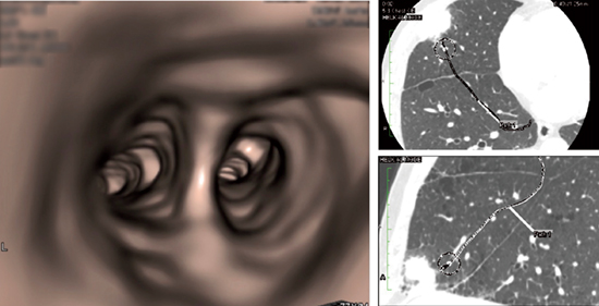 図9　症例1：右肺中葉陰影（70歳代、男性）のVBS画像
